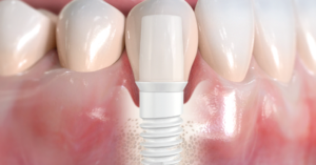 implant_1-300x285 implant_1-300x285